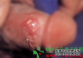 福州龟头长肉粒怎么办
