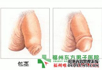 福州男人包皮过长用做手术吗?