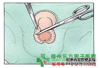 包皮环切术