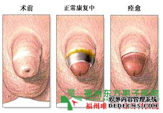 福州包皮手术费用多少?