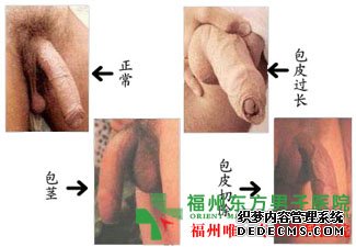 包皮垢增多危害男性健康