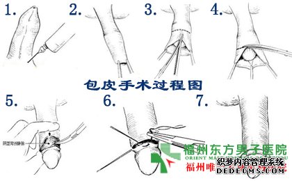 包皮过长的图片