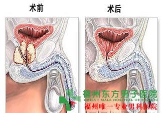 前列腺炎怎么办