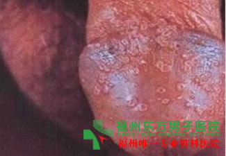 龟头痒的原因是什么？
