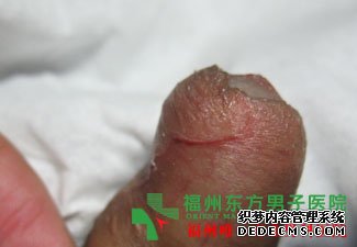 阴茎上长肉芽是怎么回事?