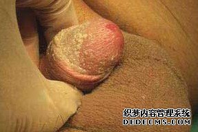 龟头会流脓状的液体是什么病？