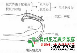 引起包皮龟头炎的原因是什么?
