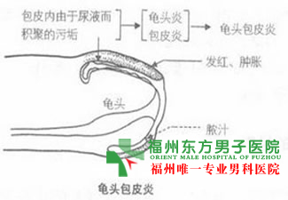 包皮溃烂应该怎么办?