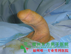 生殖器异常的症状