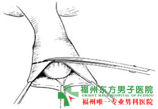 龟头发炎的症状是什么样的?