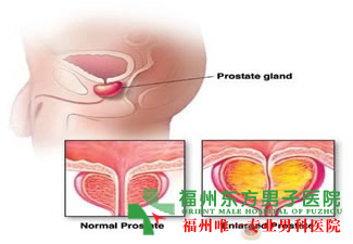 什么是淋病