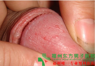 福州龟头起红点如何治疗