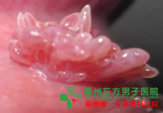 龟头长鸡冠状赘生物