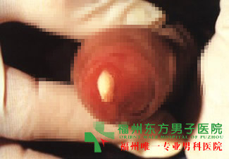 福州男人尿道口红肿是怎么回事?