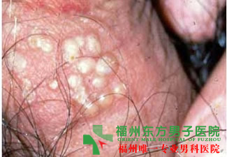 福州龟头上有白点是怎么回事