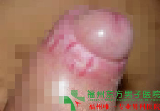 福州龟头炎要多少费用