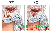 前列腺炎肥大灶与生育?
