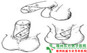 睾丸活检方法 睾丸活检方法