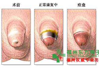 割包皮最好的医院是哪家?