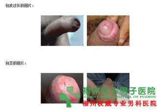 尿路感染
