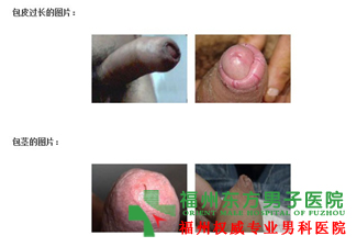 包皮过长会影响生育吗?