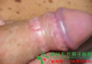 疱疹是怎么引起的？
